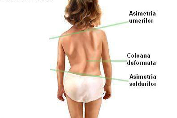Lupusul: Simptome si diagnostic Asimetria articulațiilor șoldului în tratamentul adulților