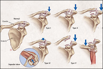 tratamentul artrozei acroviale claviculare tratamentul tendoanelor articulației cotului